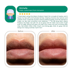 Abera Fordyce Lip Acne Cream 20ml | Gentle Care for Fordyce Spots & Lip Bumps