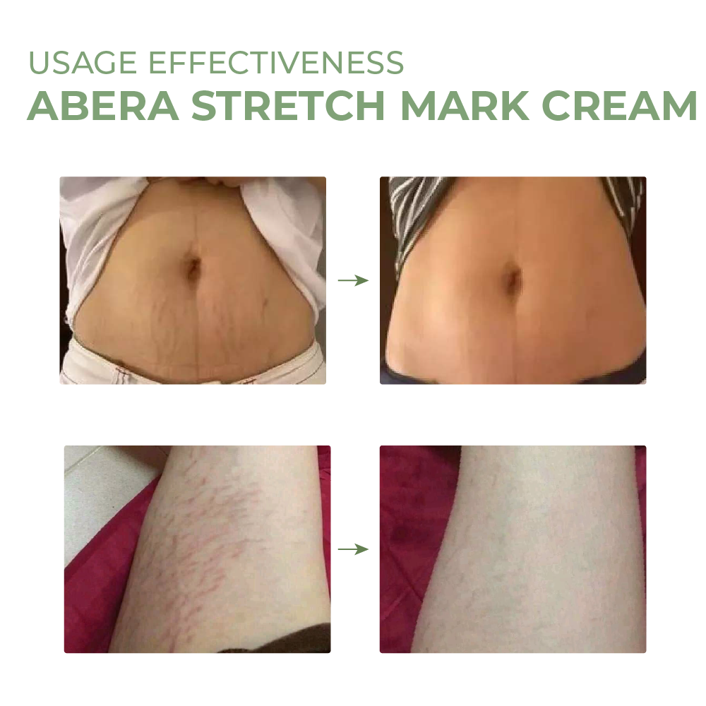 Abera Stretch Mark Cream 50ml
